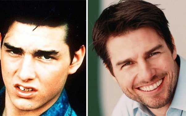 Tom Cruise Teeth Before and After Tom Cruise Teeth Before and After