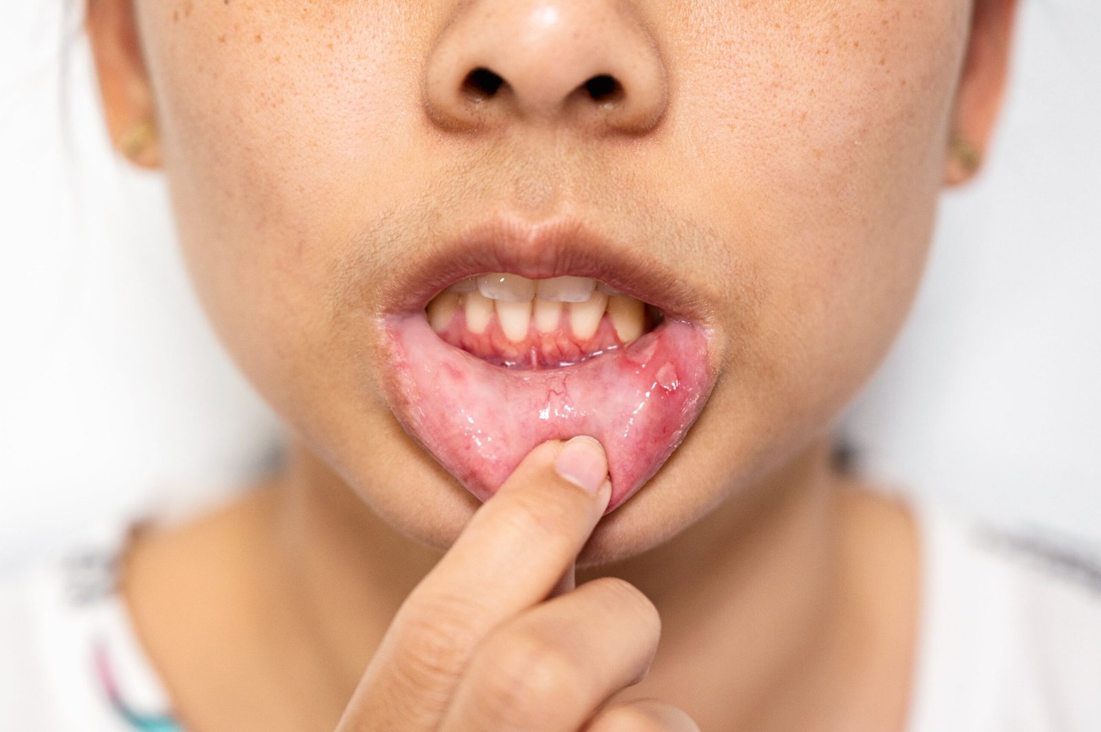 Can allergies cause sore throat Can allergies cause sore throat